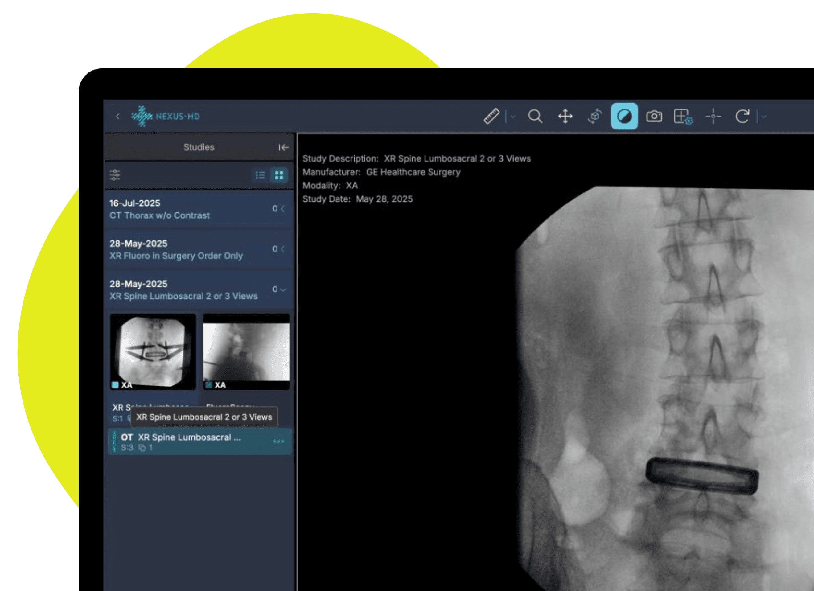 Nexus-MD DICOM Viewer interface showing XR Spine Lumbosacral study with patient imaging data and diagnostic tools